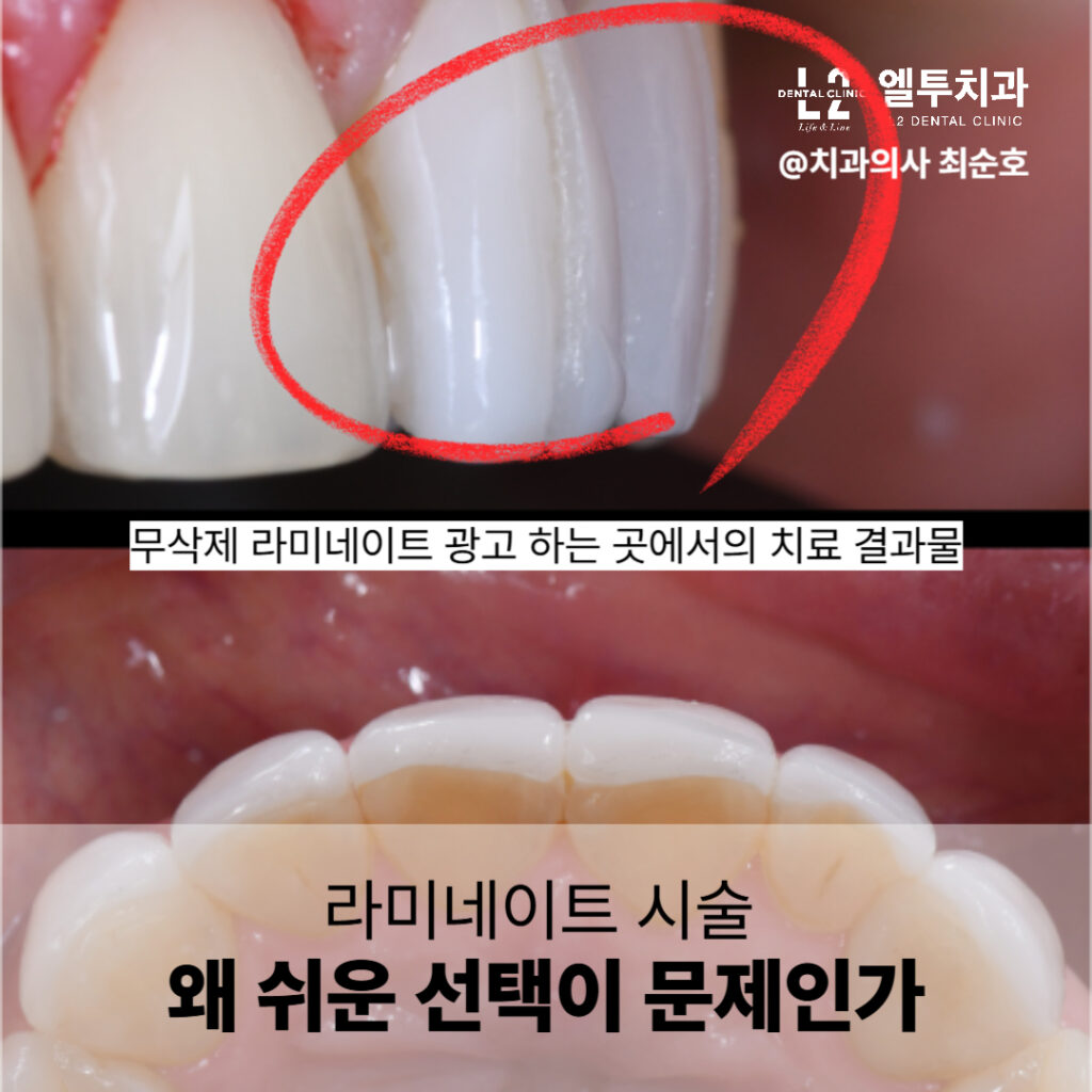 부작용이 나타난 무삭제 라미네이트 사례 비교