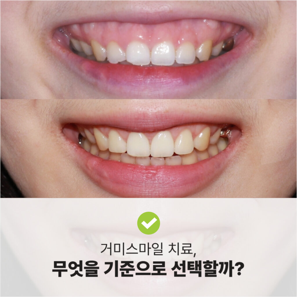 거미스마일 환자의 시술 전후 미소 비교, 아래는 개선된 상태