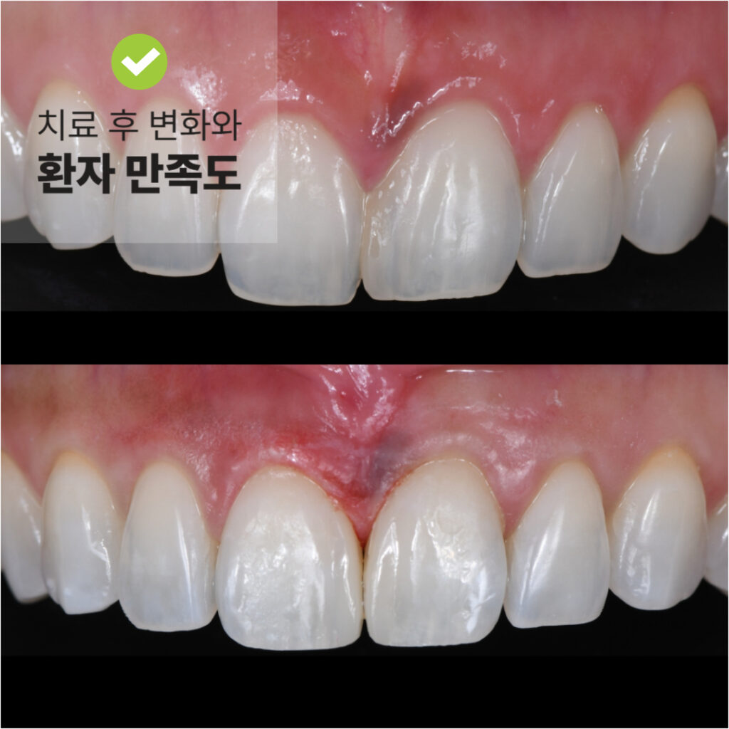 "복합레진 치료 전후의 앞니 상태 비교 이미지와 환자 만족도 강조"