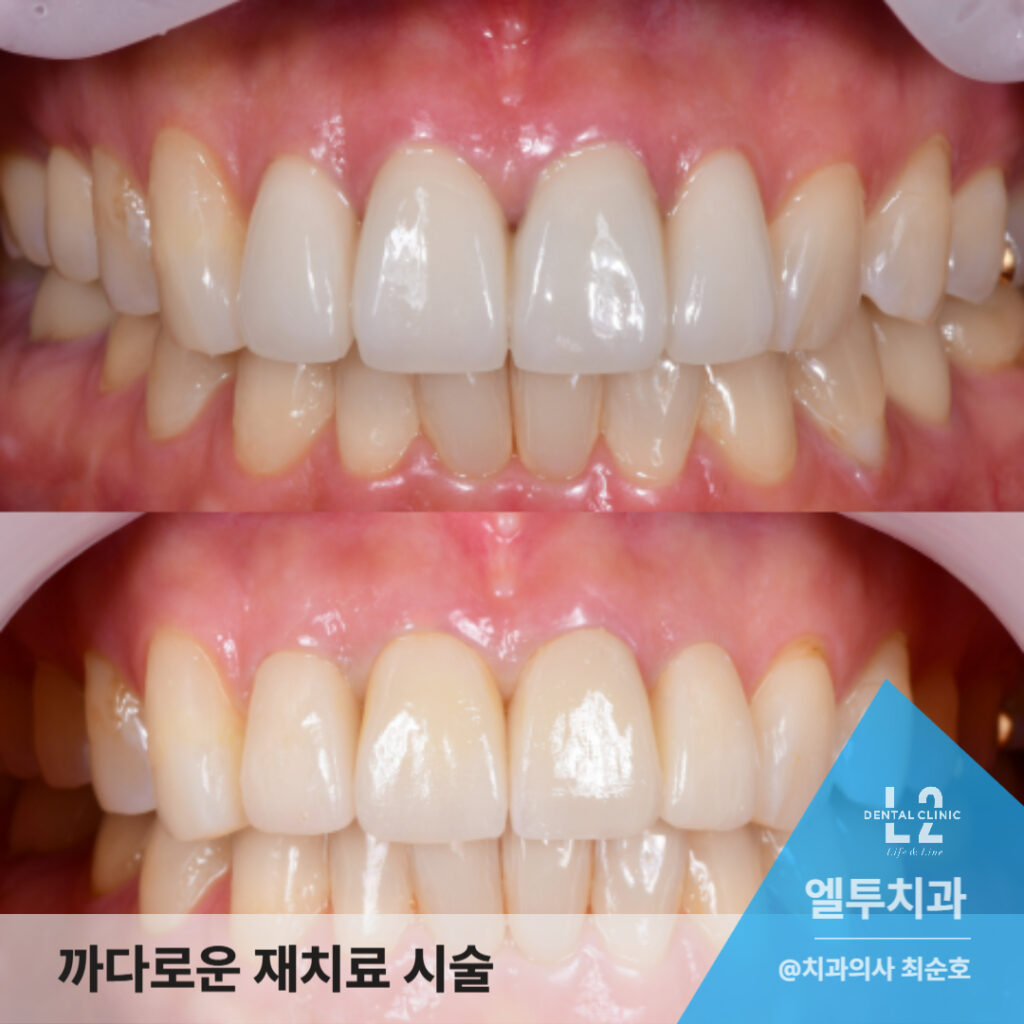 앞니 크라운 재치료 전후 비교 이미지