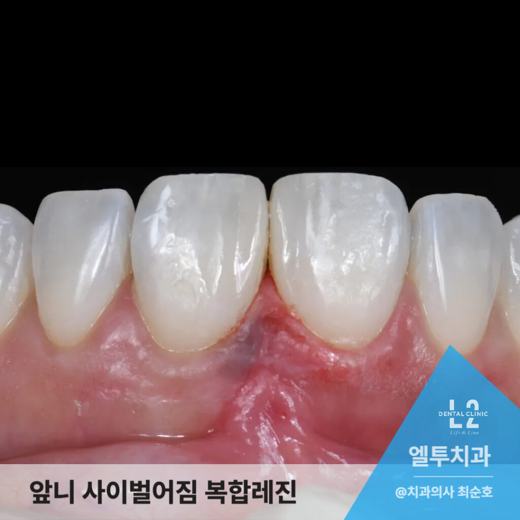"복합레진 치료 후 완성된 앞니 모습으로 대칭성과 광택이 강조된 이미지"