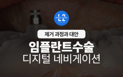 임플란트수술, 디지털 네비게이션으로 완성한 60대 전체임플란트 사례
