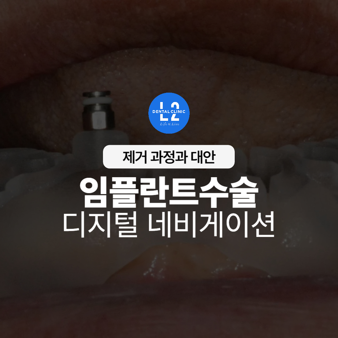 임플란트 수술 디지털 네비게이션 안내 이미지