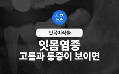 잇몸염증, 고름과 통증이 보이면 절대 방치하지 마세요