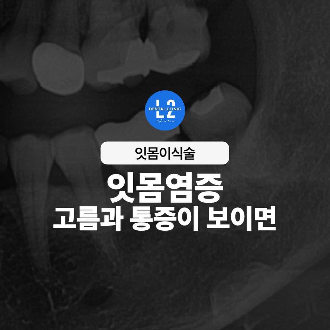 엑스레이 사진에 나타난 잇몸염증과 고름 증상