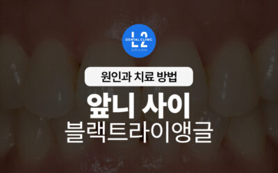 앞니 사이 블랙트라이앵글, 원인과 치료 방법 총정리