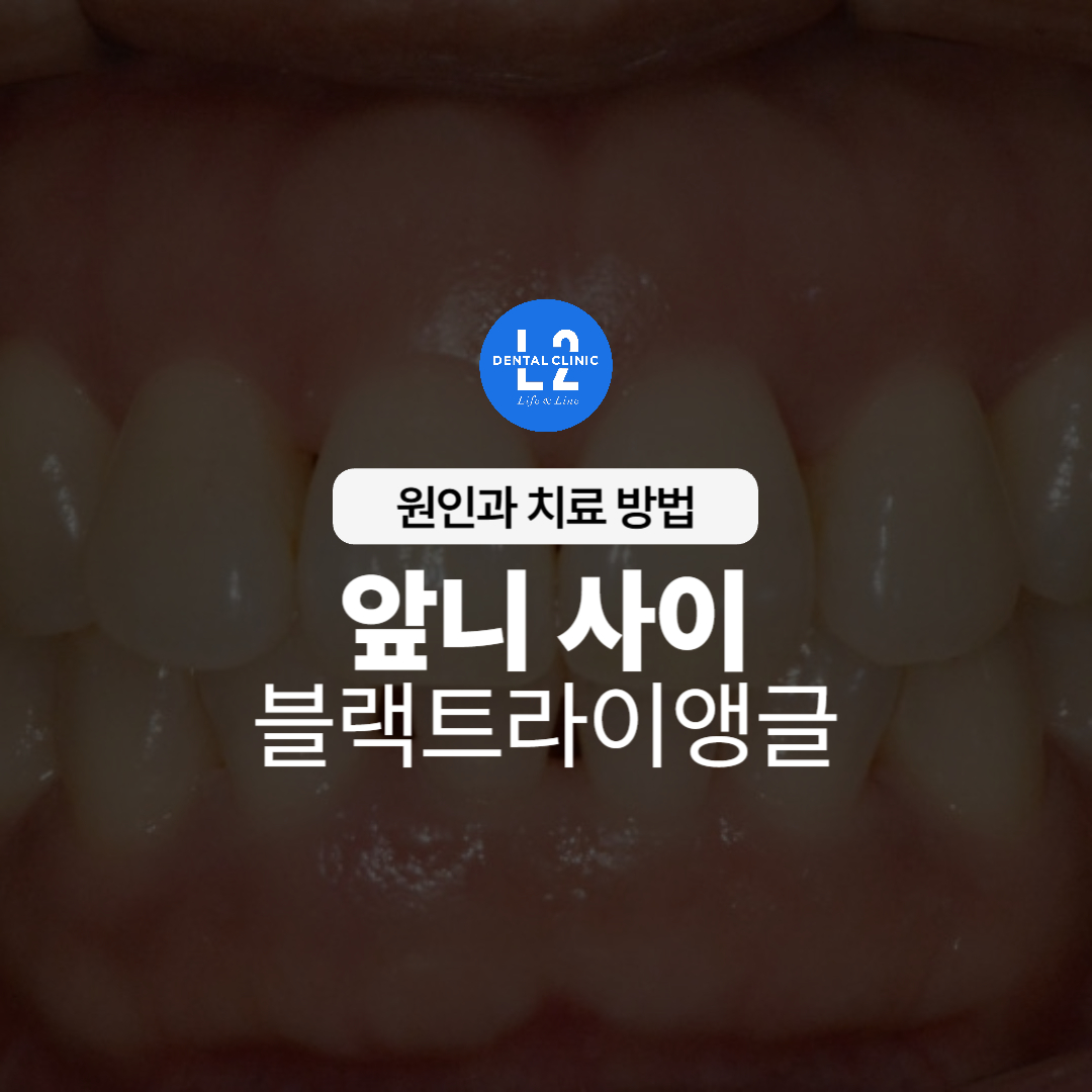앞니 사이 블랙트라이앵글의 원인과 치료 방법 설명 이미지
