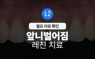 앞니벌어짐 레진 치료, 왜 필요할까요?
