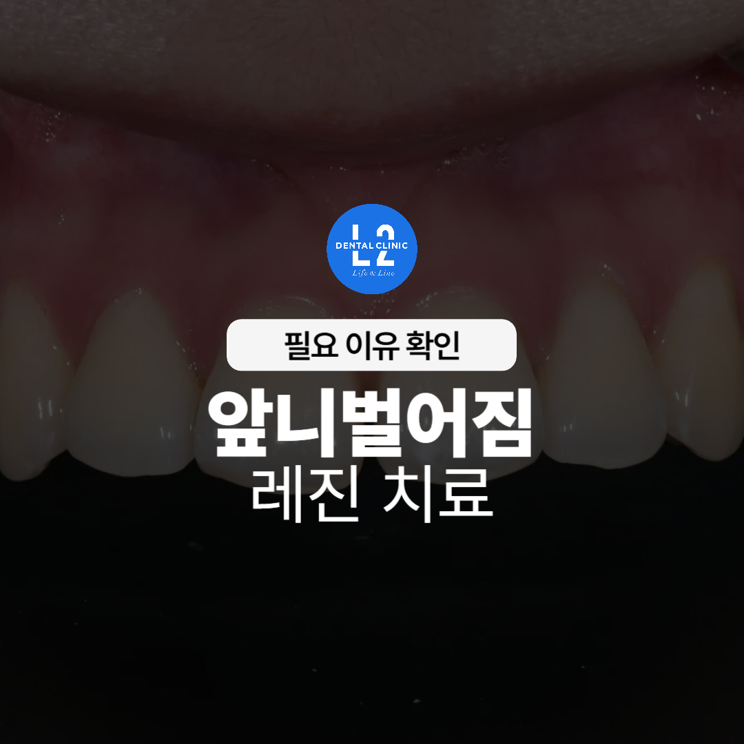 앞니 사이 벌어짐 레진 치료 필요성 안내 이미지