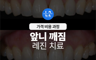 앞니 깨짐 레진치료, 가격 비용과 과정 총정리