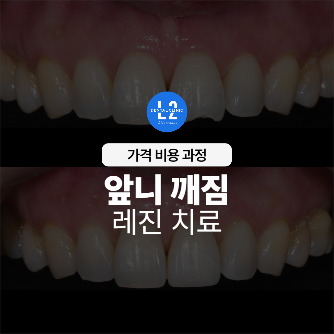 앞니 깨짐 레진 치료 전후 비교 이미지