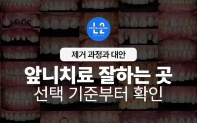 앞니치료 잘하는 곳, 선택 기준부터 다릅니다