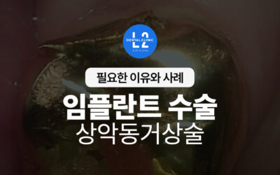 임플란트 수술과 상악동거상술, 꼭 필요한 이유와 실제 사례
