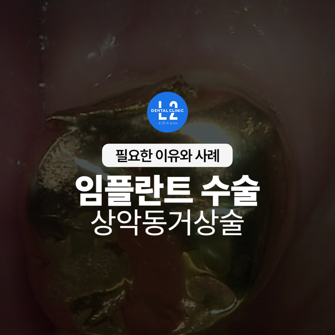 임플란트 수술 상악동거상술 관련 안내 이미지