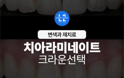 치아라미네이트 변색과 재치료, 크라운 선택 기준까지