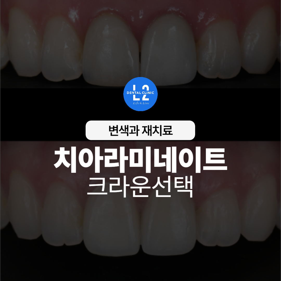 치아 라미네이트와 크라운 치료 전후 사진