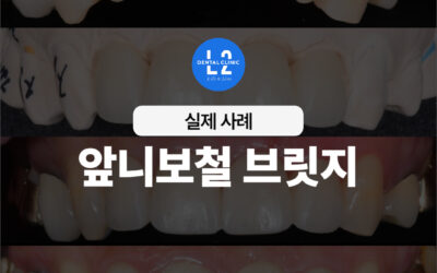 앞니보철 브릿지 치료, 임플란트와 다른 점과 실제 사례