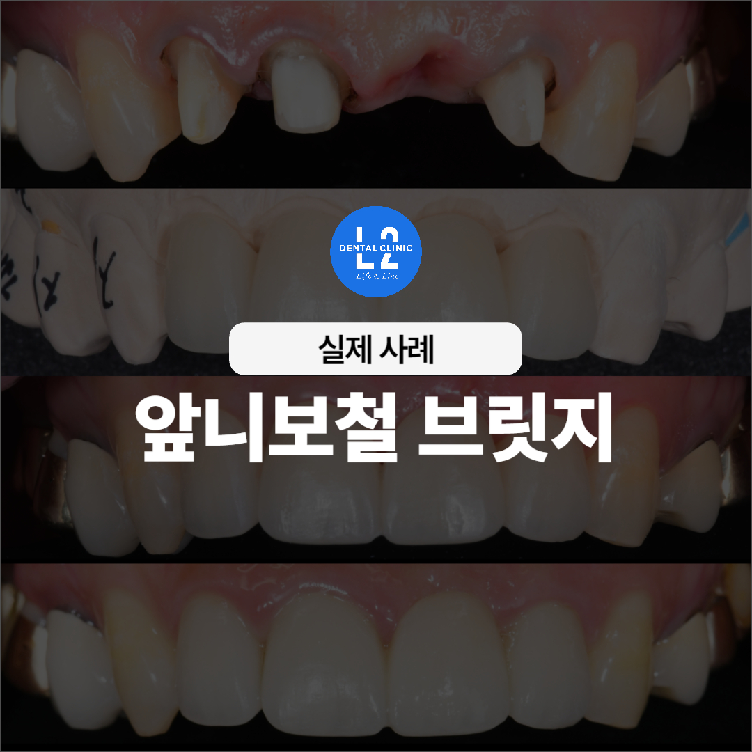 앞니보철 브릿지 실제 사례 이미지