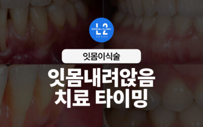 잇몸이식술 언제 받아야 할까? 잇몸내려앉음 치료 타이밍