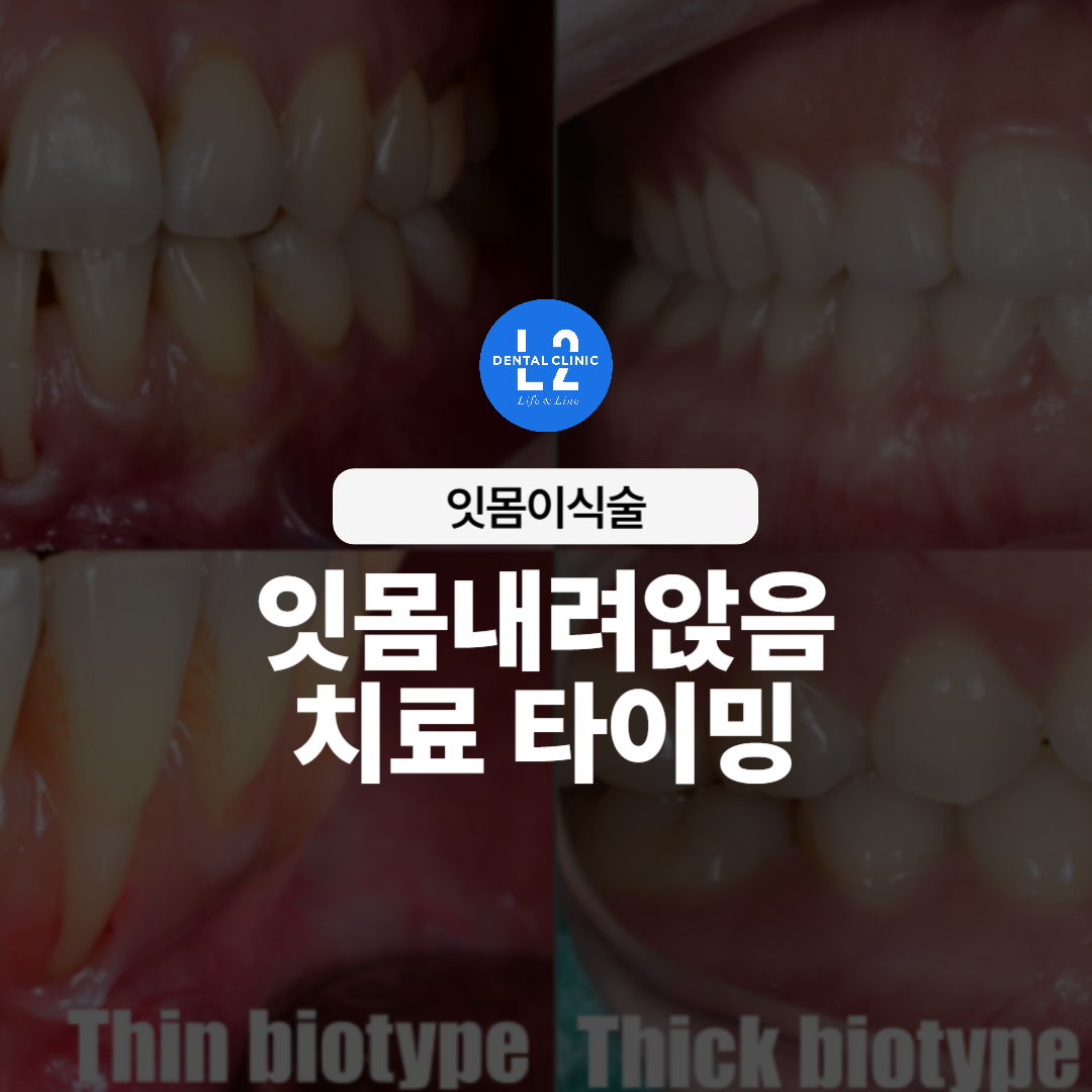 Thin biotype과 Thick biotype 비교를 통해 본 잇몸이식술 필요성