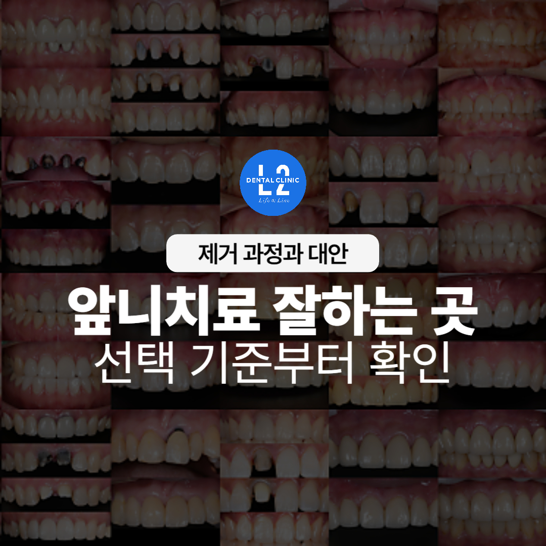 여러 환자들의 앞니 치료 전후 사례 모음 이미지