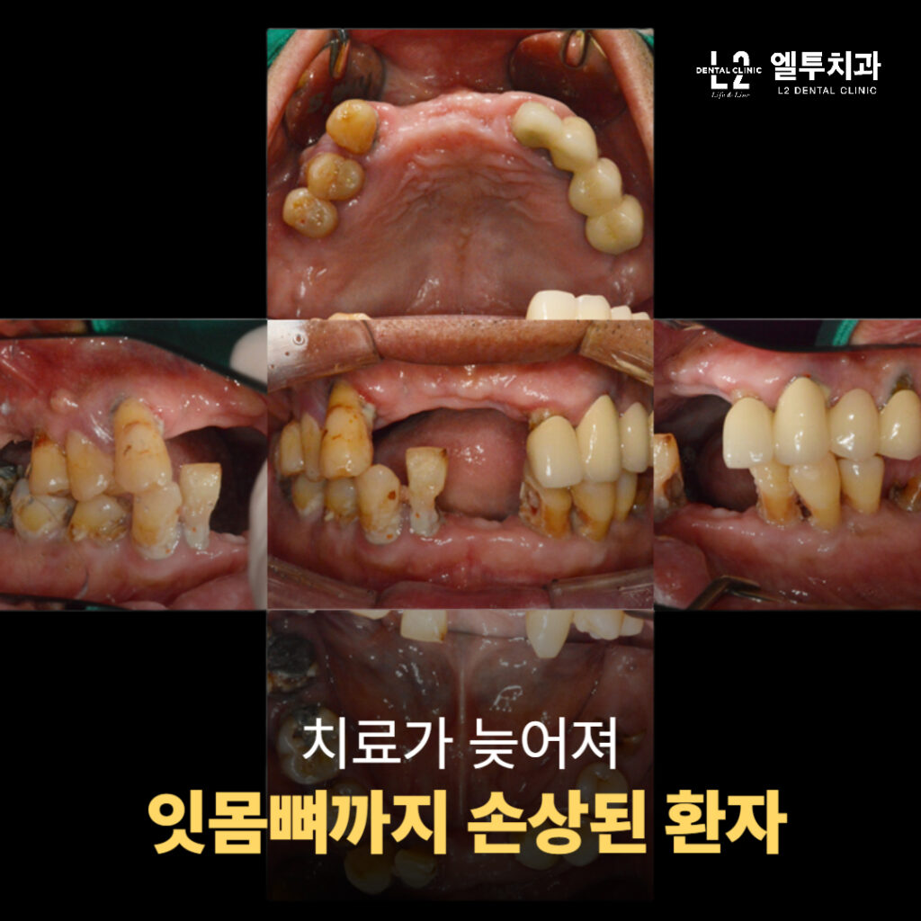 치료가 늦어 잇몸뼈까지 손상된 환자의 치아 상태