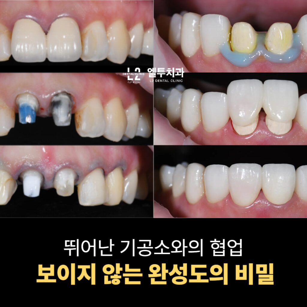 앞니 보철 치료 과정 중 치아 기공물 제작 협업 사례
