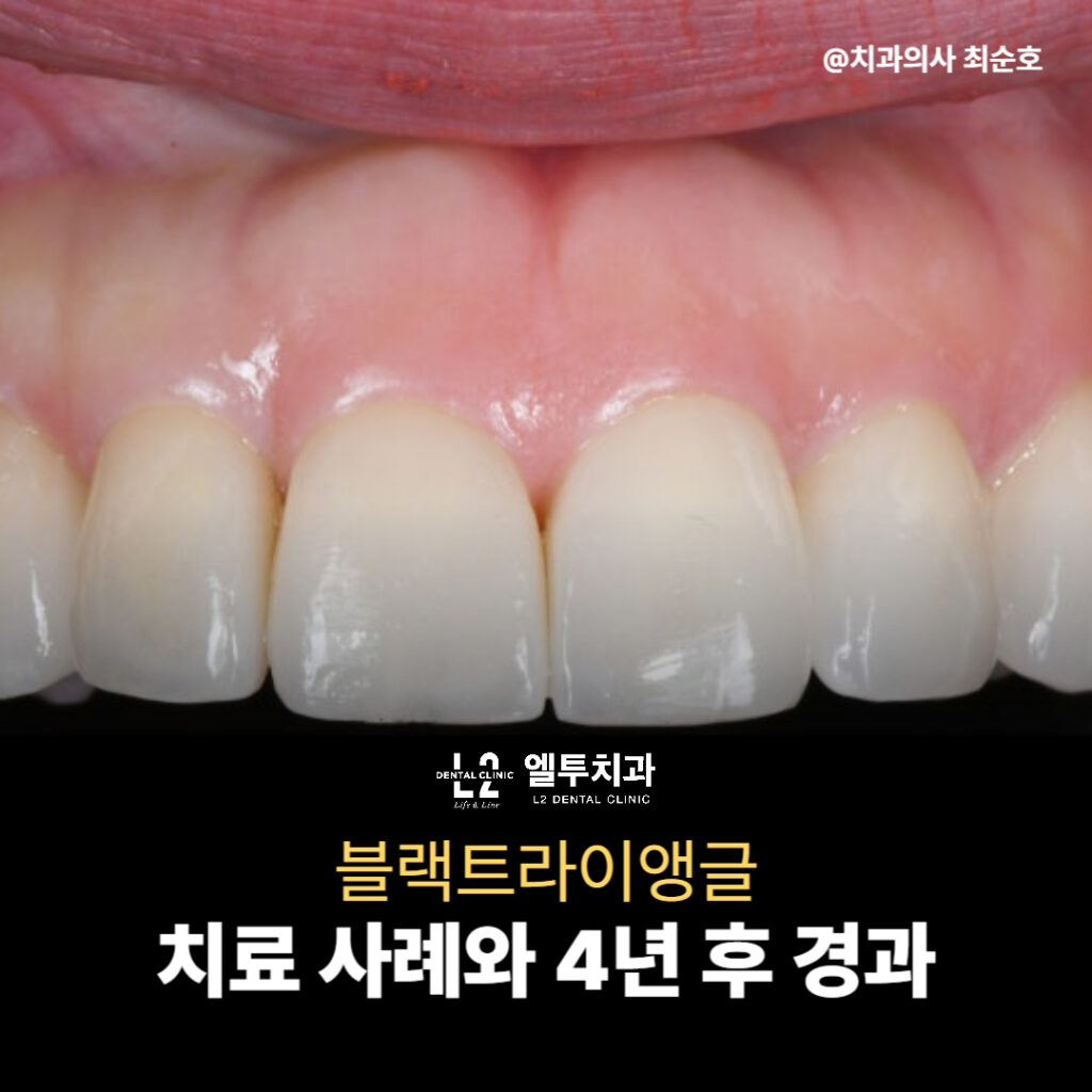블랙트라이앵글 치료 사례와 4년 후 경과 이미지