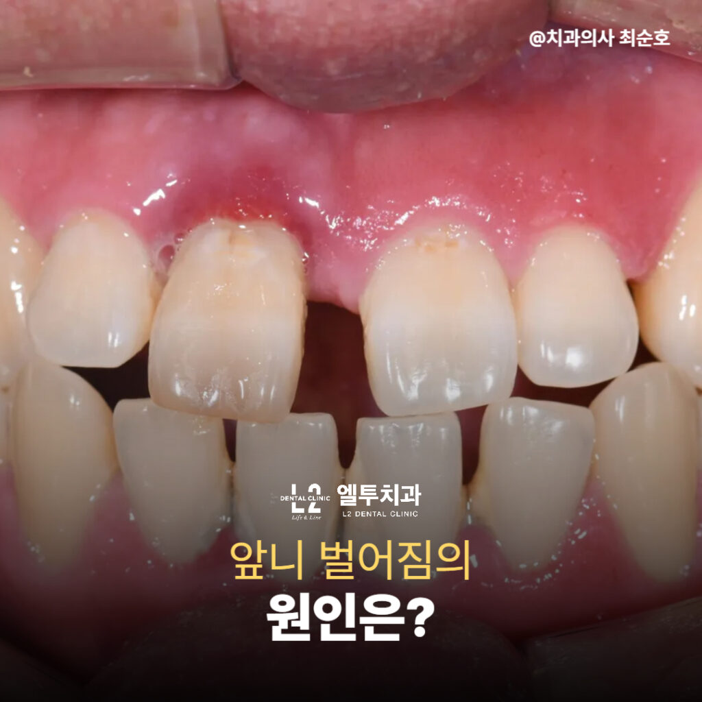 앞니 벌어짐 원인을 설명하는 이미지