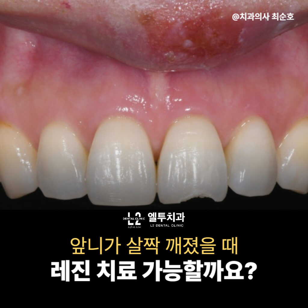 앞니가 살짝 깨진 모습