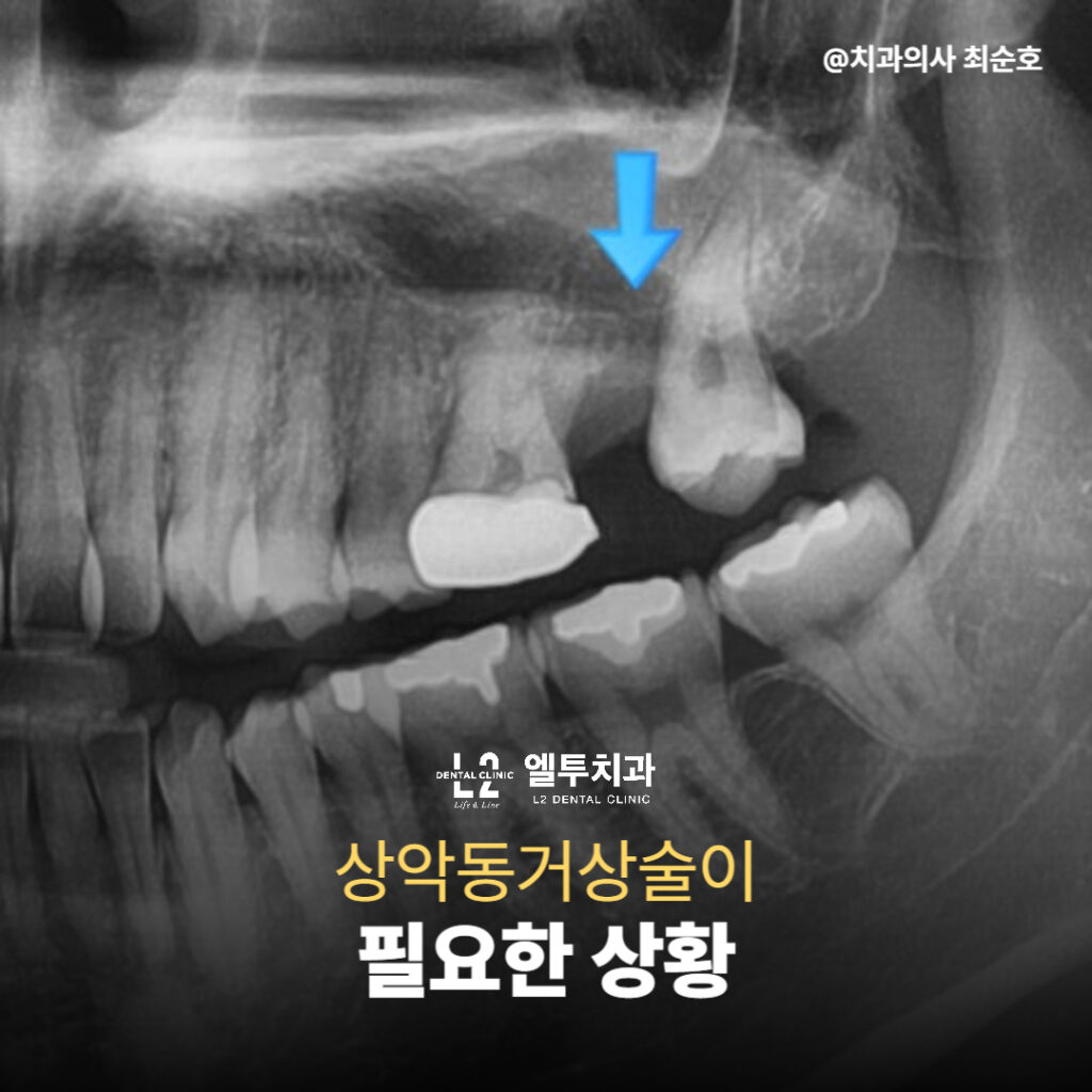 상악동거상술 필요성을 설명하는 엑스레이 이미지