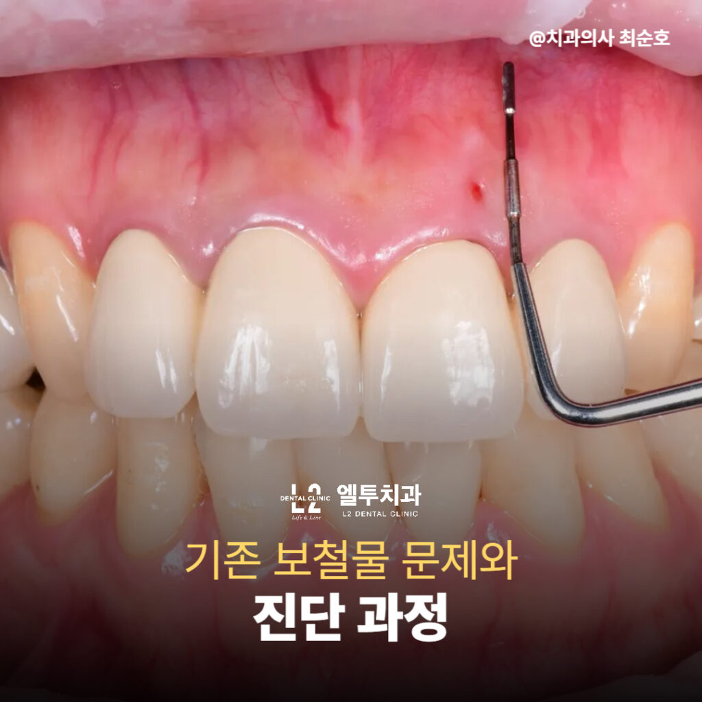 기존 앞니보철 보철물 문제 진단 과정 이미지