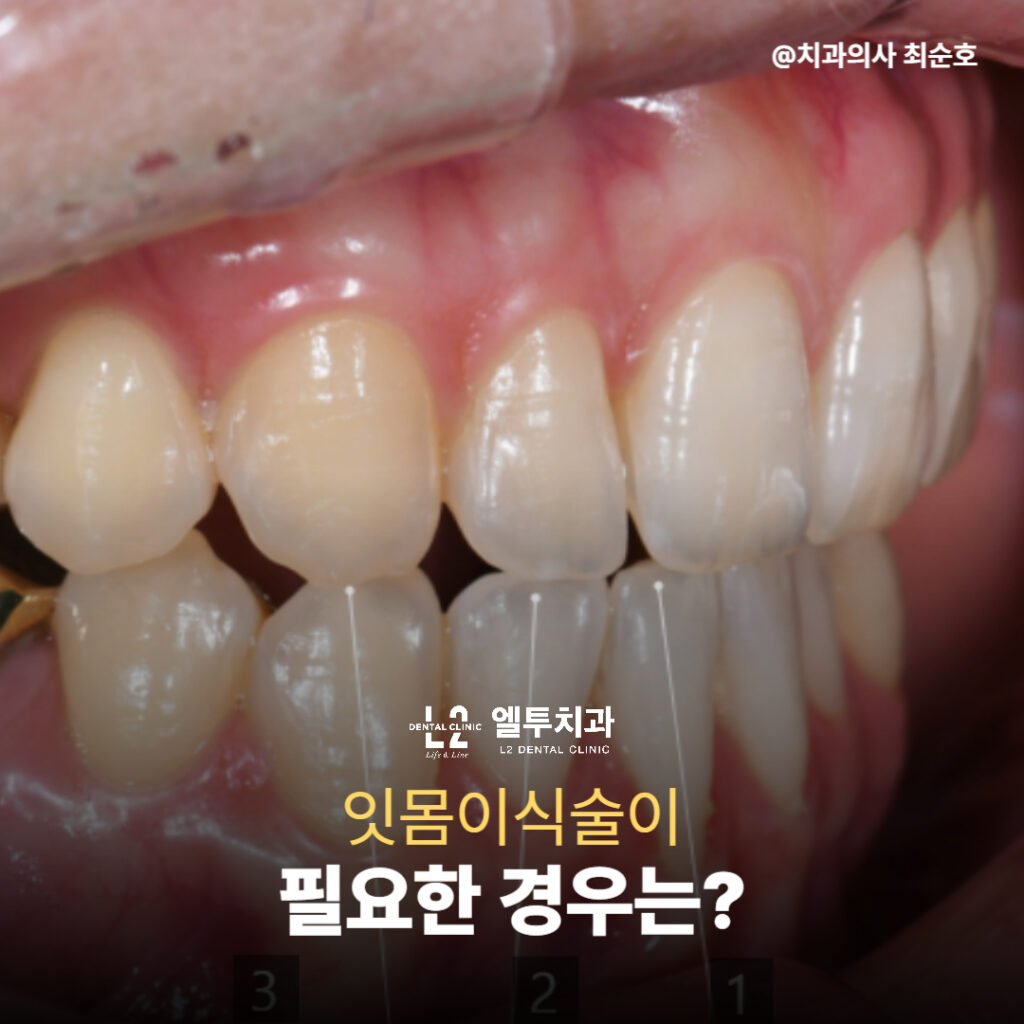 잇몸이식술이 필요한 실제 임상 사진