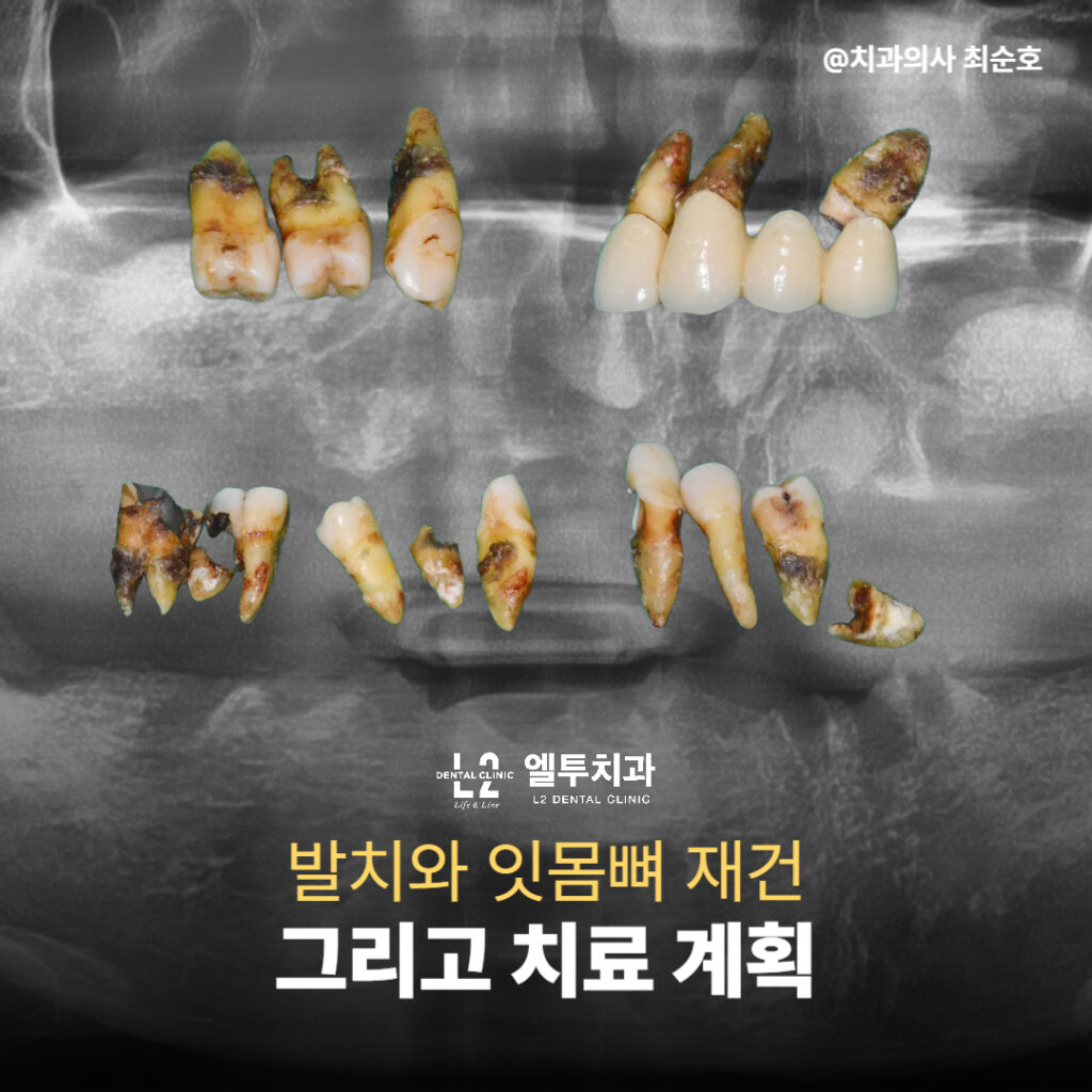 발치 후 잇몸뼈 재건 및 치료계획