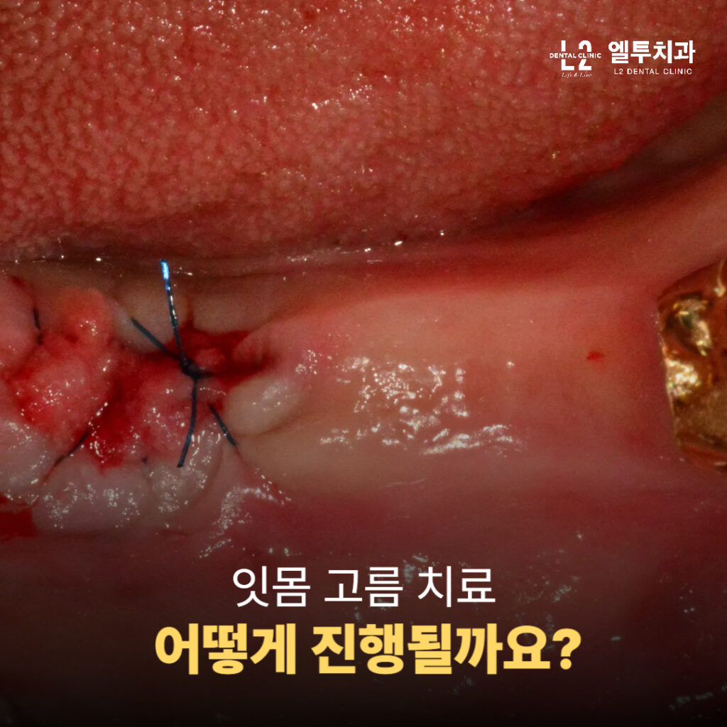 잇몸을 절개하고 봉합된 상태의 치주 수술 사진