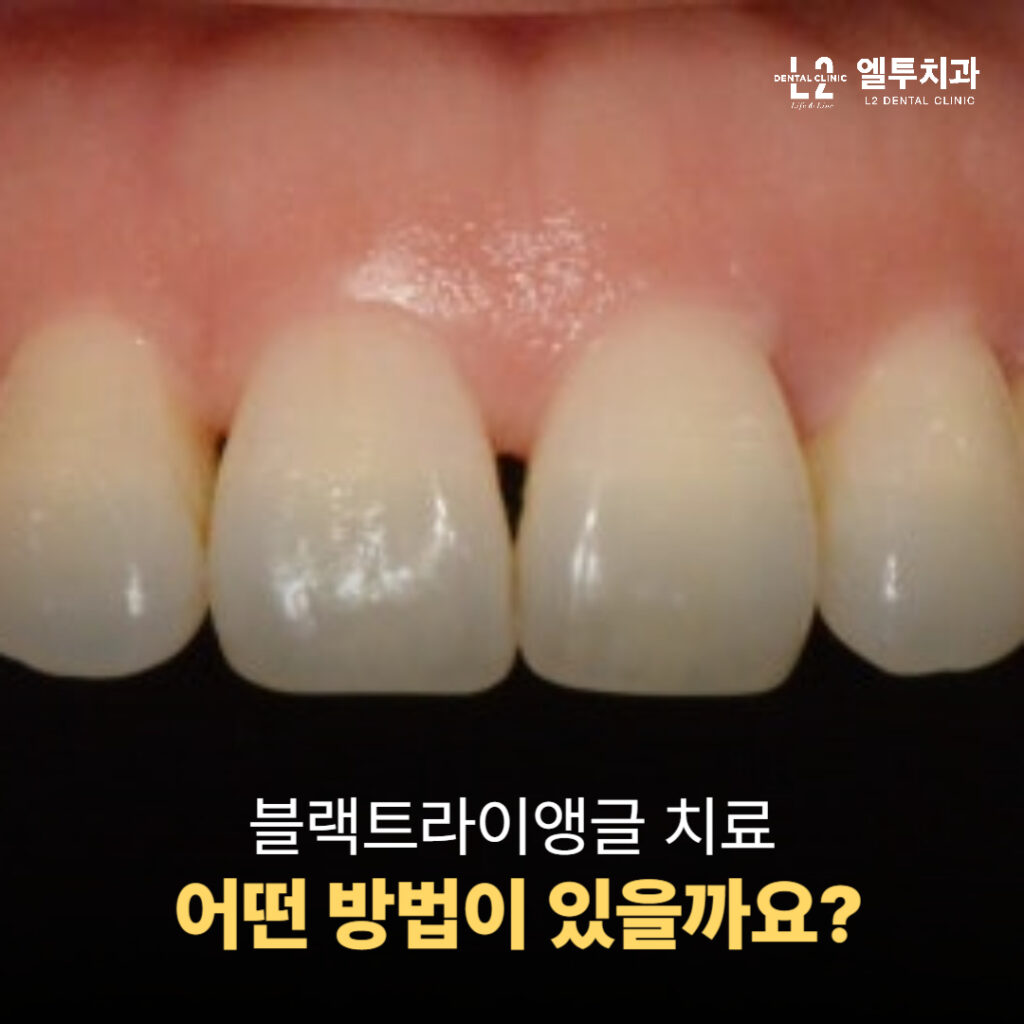 블랙트라이앵글 치료 방법 안내 이미지