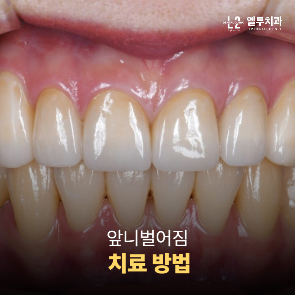 앞니 벌어짐 치료 방법 안내 이미지