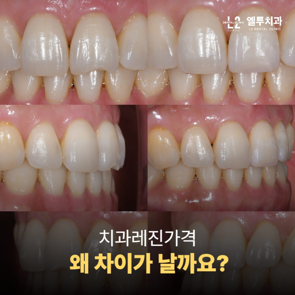 앞니 레진 치료 사례들
