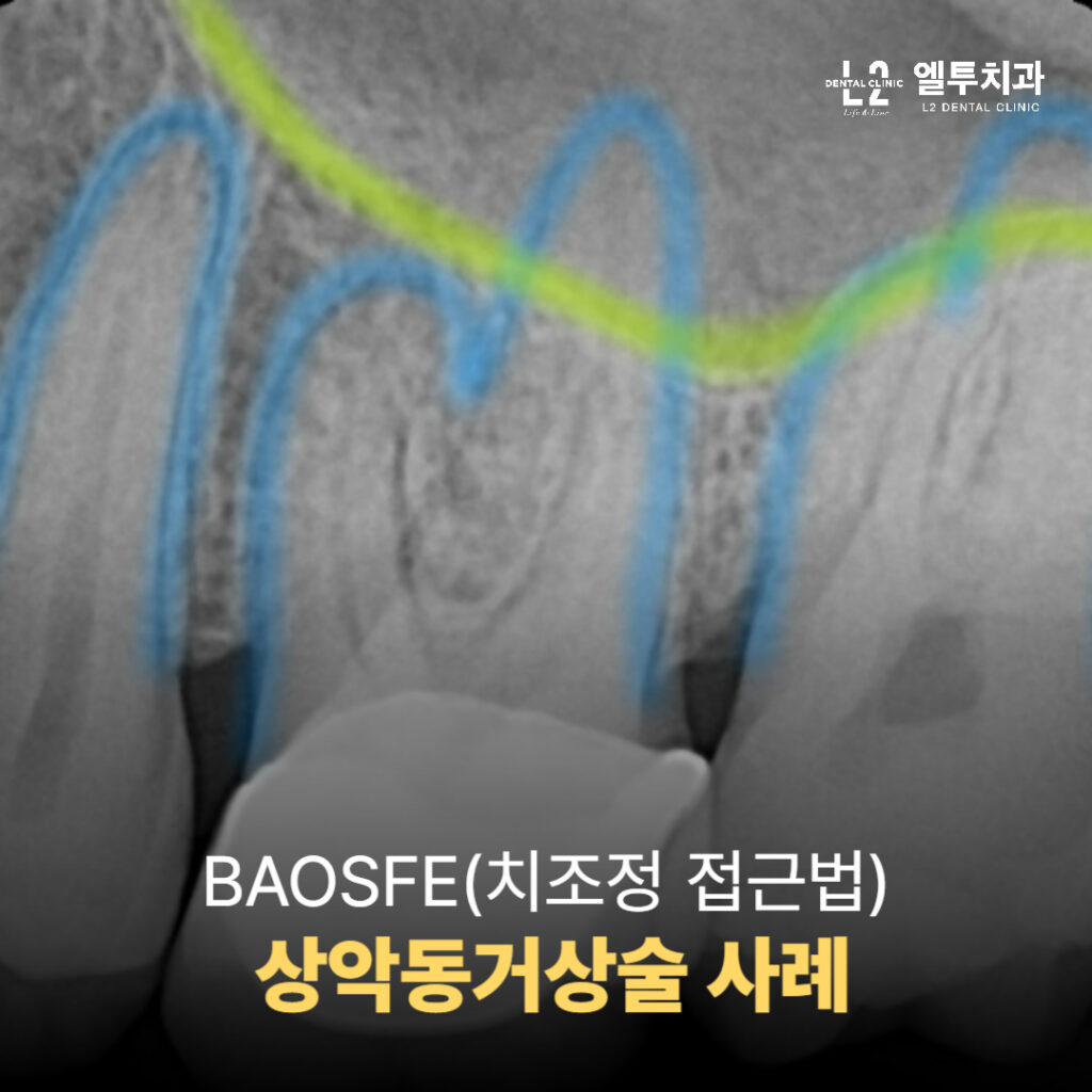 BAOSFE 접근법으로 진행한 상악동거상술 사례