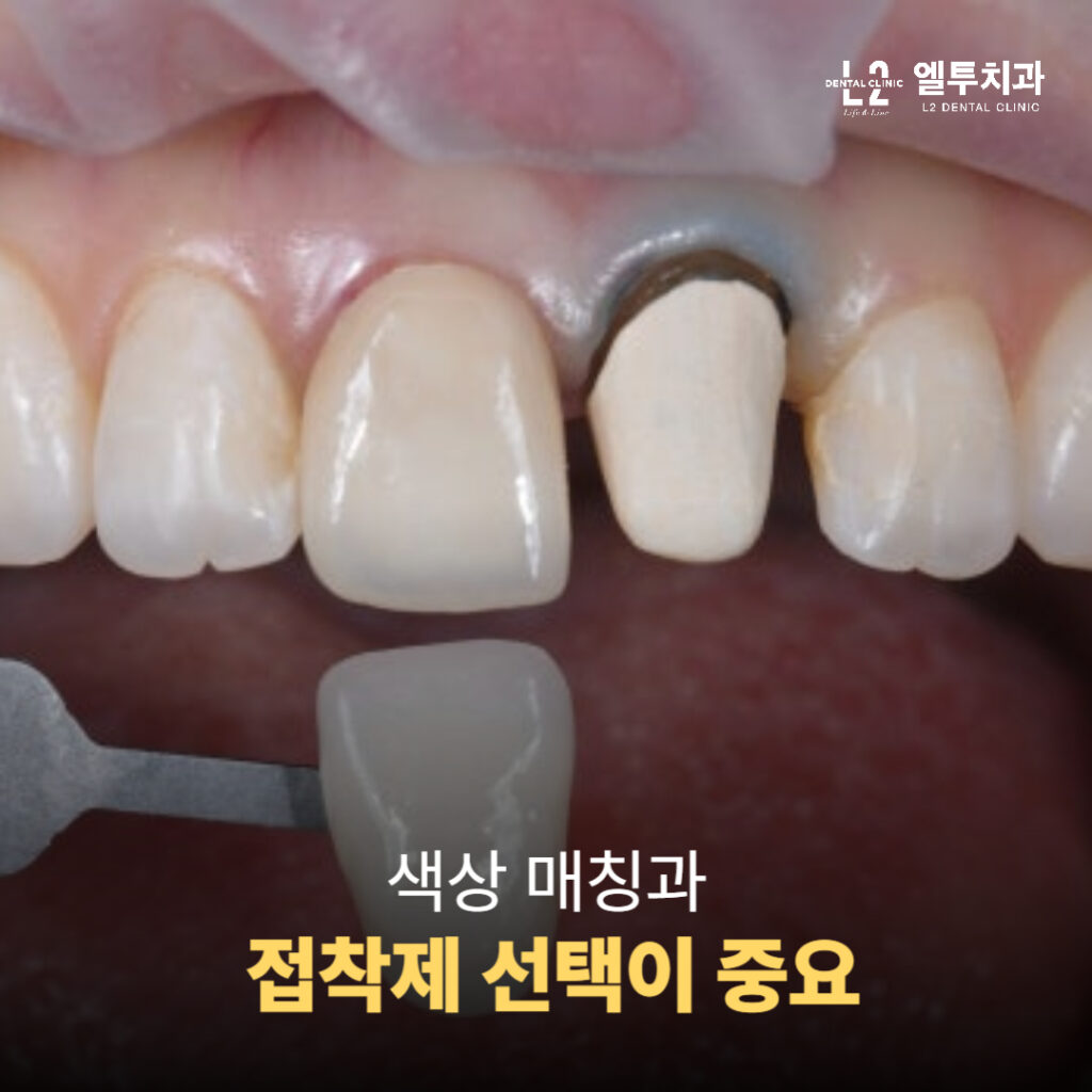치아 크라운 색상 매칭 과정