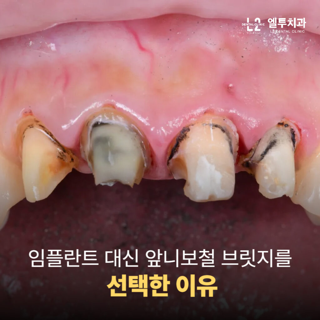 임플란트 대신 앞니보철 브릿지를 선택한 이유