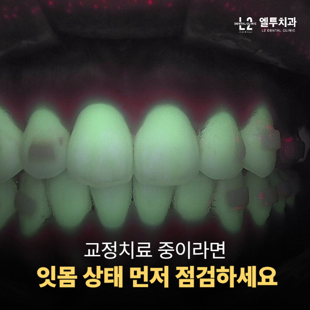 교정 중인 환자의 잇몸 상태 형광검사 사진
