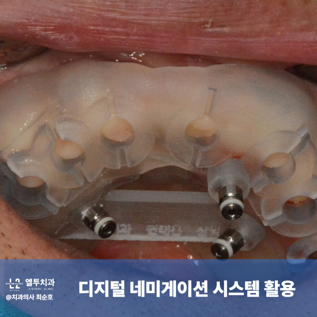 디지털 네비게이션 시스템 활용 임플란트 수술