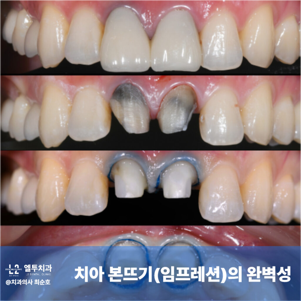 치아 본뜨기(임프레션) 과정의 전후 이미지