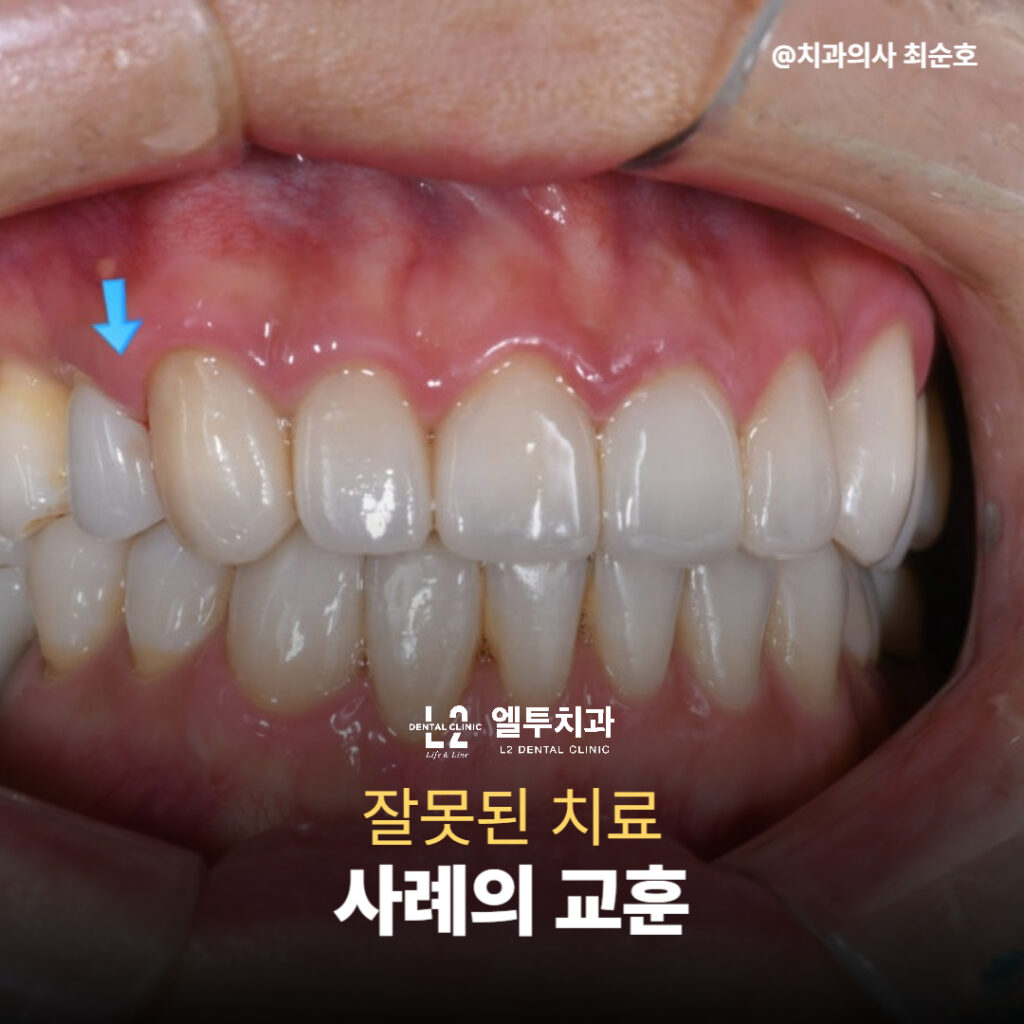 블랙트라이앵글 잘못된 치료 사례 이미지