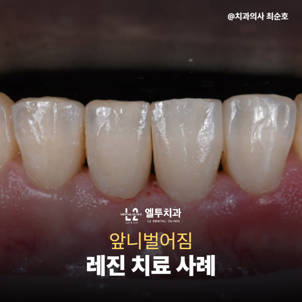 앞니벌어짐 레진 치료 실제 사례 이미지