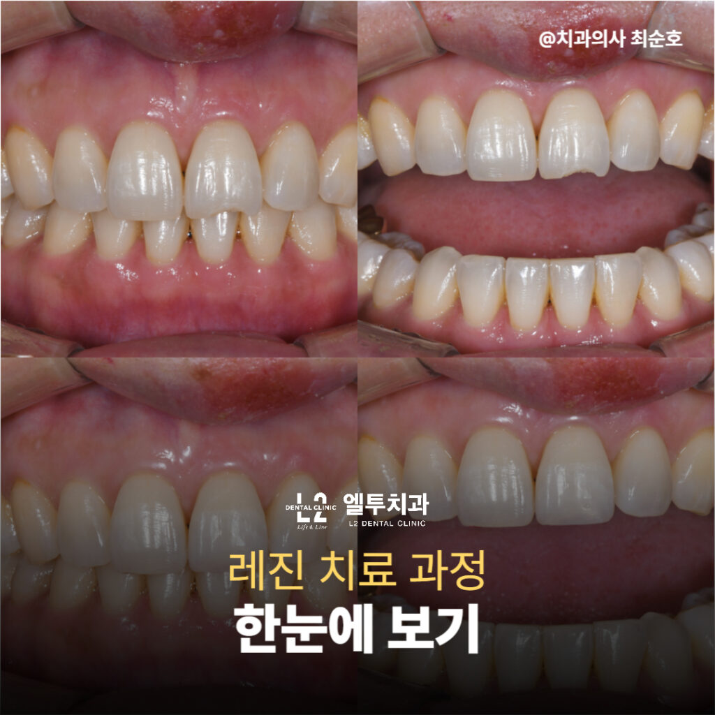 앞니 레진 치료 과정 전후 비교