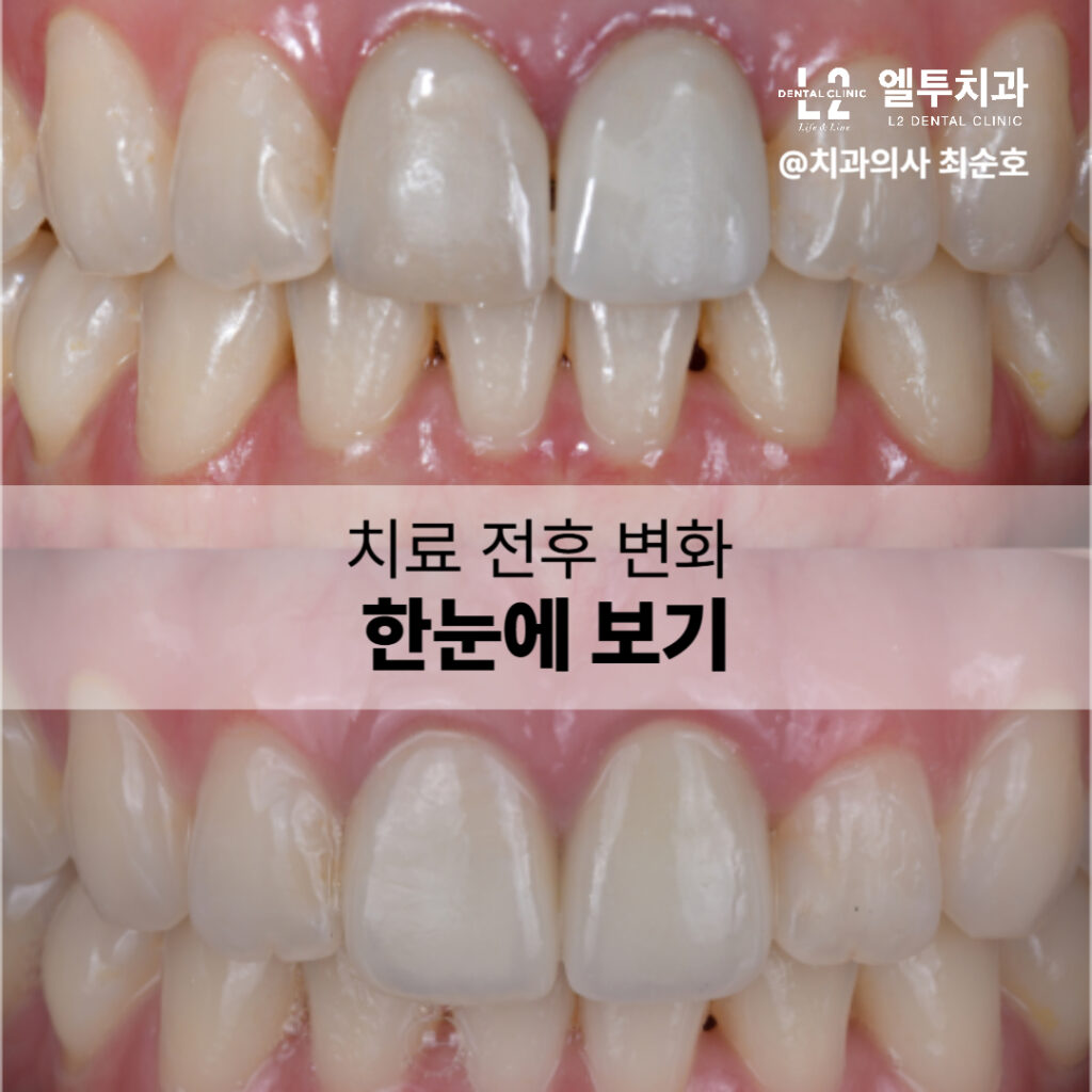 치아 라미네이트 치료 전후 비교 사진