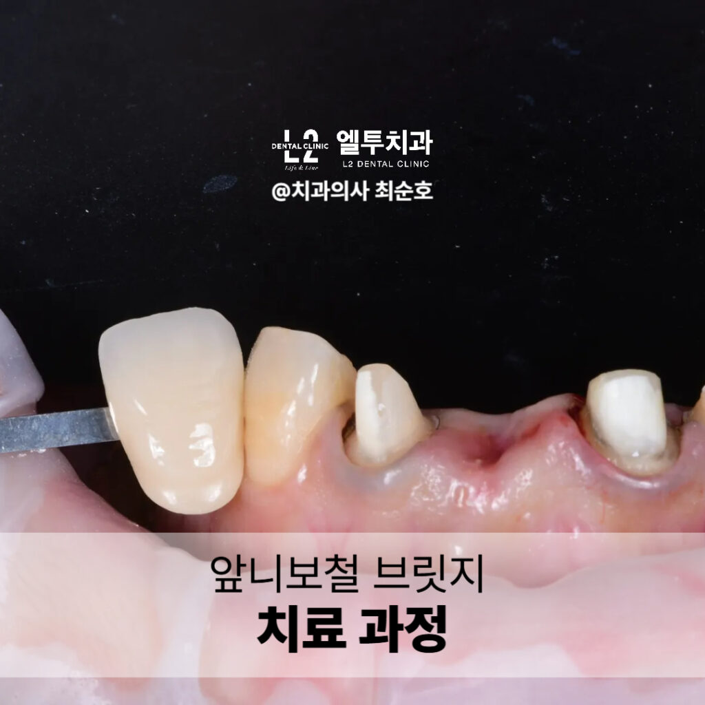 앞니보철 브릿지 치료 과정 중 임시 보철물 장착 모습