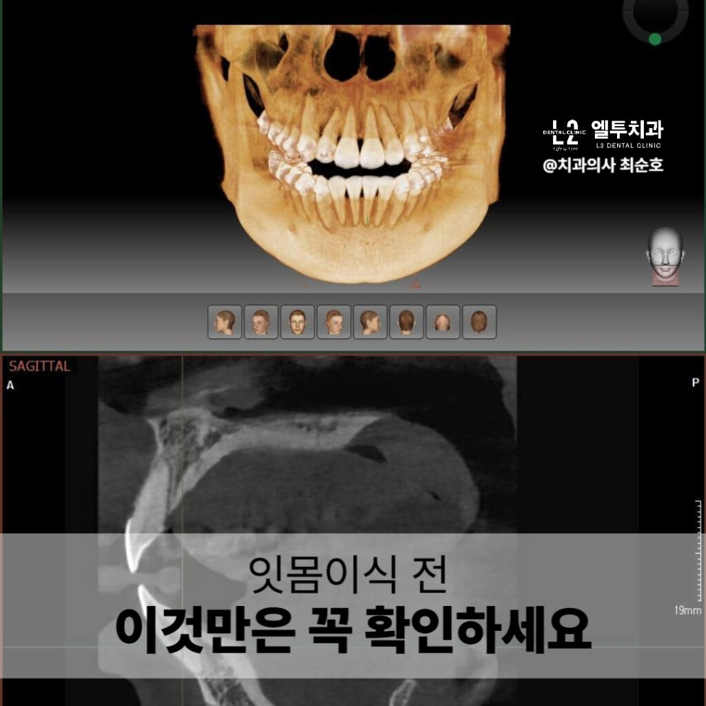 잇몸이식 전 CT 스캔 이미지 및 턱골 구조 확인 사진